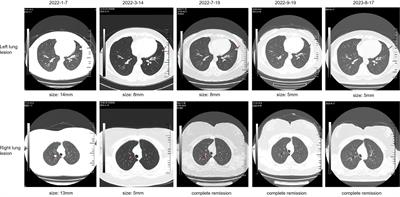 Case Report: Successful immune checkpoint inhibitor-based rechallenge in a patient with advanced renal clear cell cancer